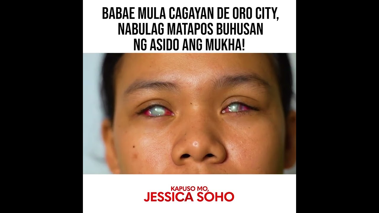 Babae mula Cagayan de Oro City, nabulag matapos buhusan ng asido ang mukha | Kapuso Mo, Jessica Soho