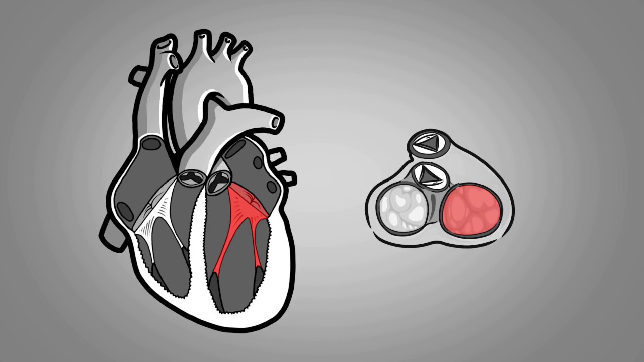Le prolapsus mitral - français