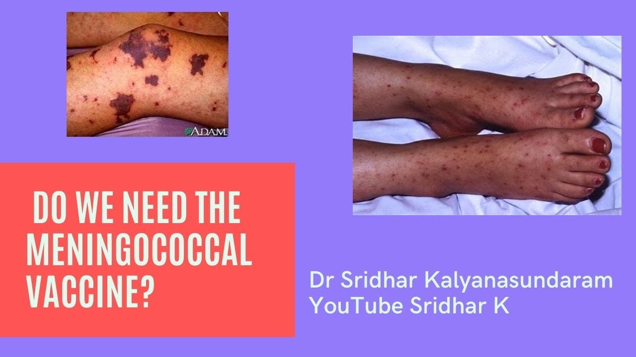 Meningococcal vaccine-do we need to give and when do we give it? Dr Sridhar Kalyanasundaram