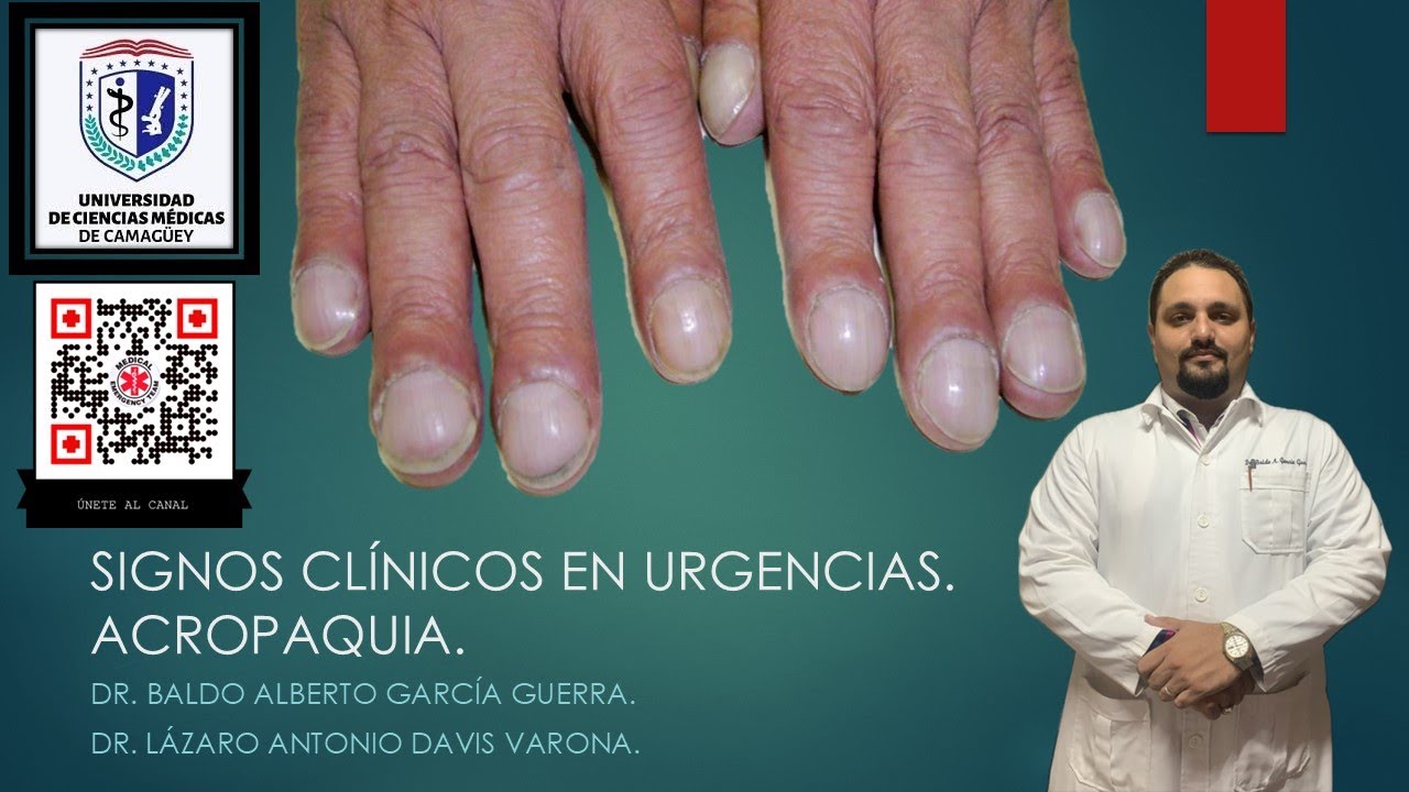 TU SALUD EST&Aacute; EN RIESGO SI TUS DEDOS SE VEN ASI .ACROPAQUIA