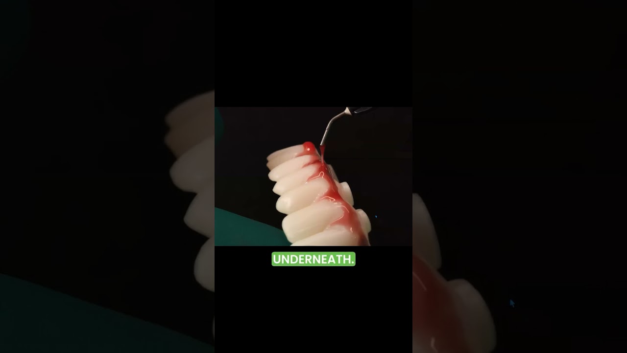 Harvest EasyGum&reg; Modifiers | Realistic Gingiva Made Simple