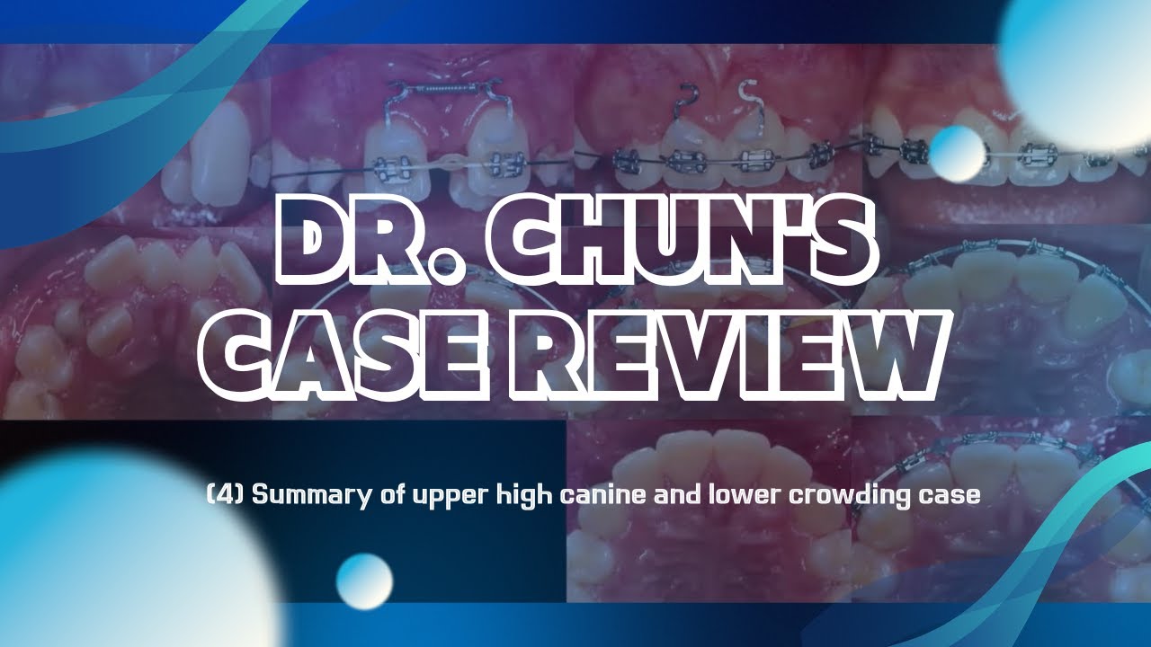 Dr. Chun's case review | (4) Summary of upper high canine and lower crowding case
