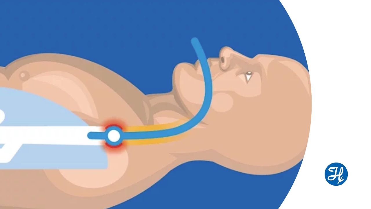 Meet our automatic cuff pressure controller: IntelliCuff