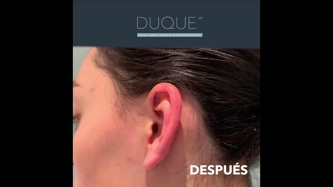 Tratamiento de Tumor Queloide en Pabell&oacute;n Auricular