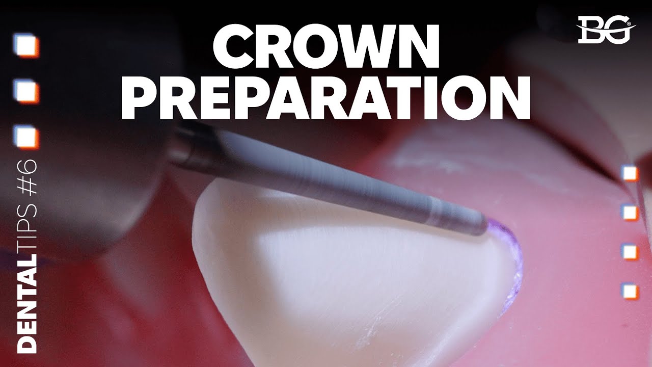 Two-plane preparation for a crown without undercuts