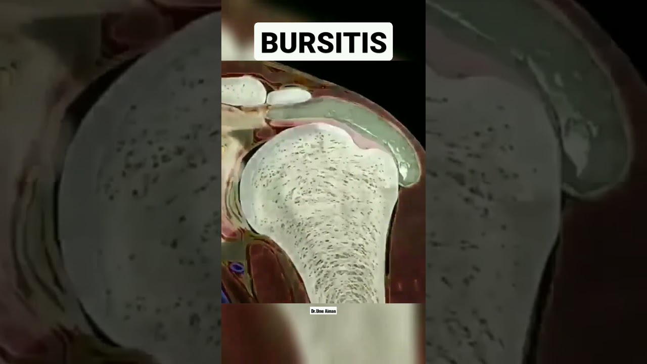 Bursitis #bursitis #bursa #inflammation #physicaltherapy#shoulder #pain #shorts #movement #anatomy