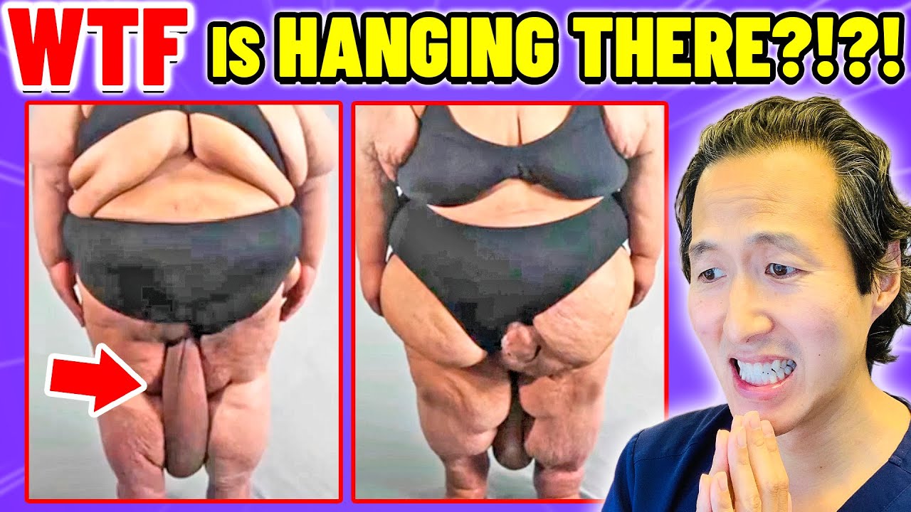 HUGE Mass! Plastic Surgeon Reacts to BOTCHED BARIATRICS!