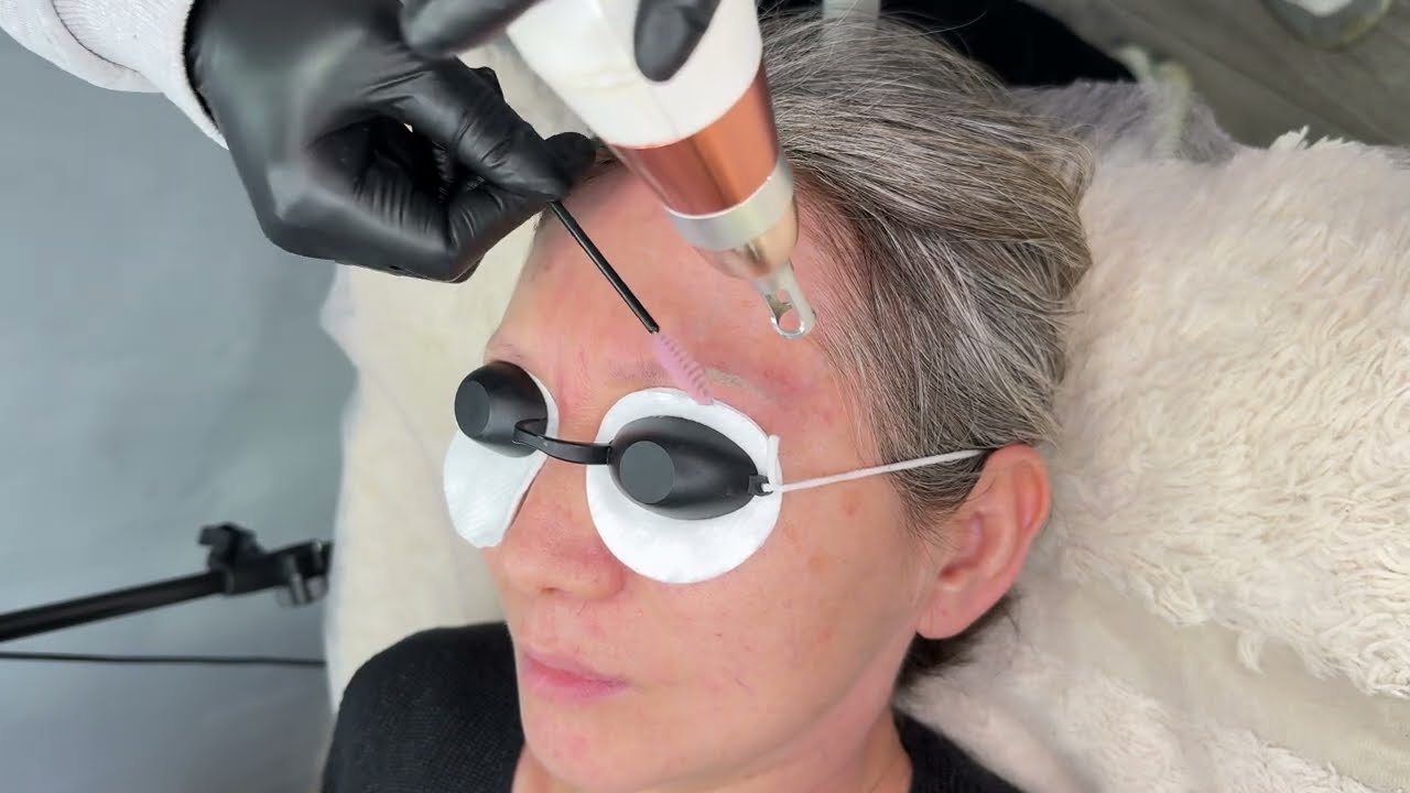 Picosecond laser removal machine / orange eyebrow tattoo removal 