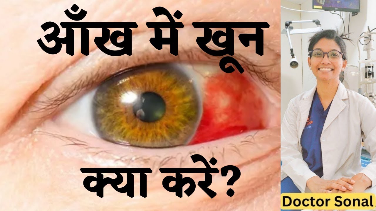 आँखों में खून जम जाए तो क्या करें?  Causes and treatment of Blood in the Eye| Doctor Sonal