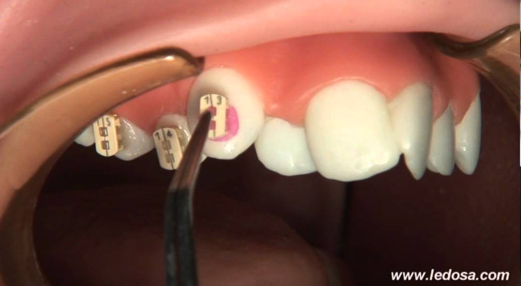 ORTOCERVERA / Ortodoncia: Cementado de Brackets Autoligado Camaleón
