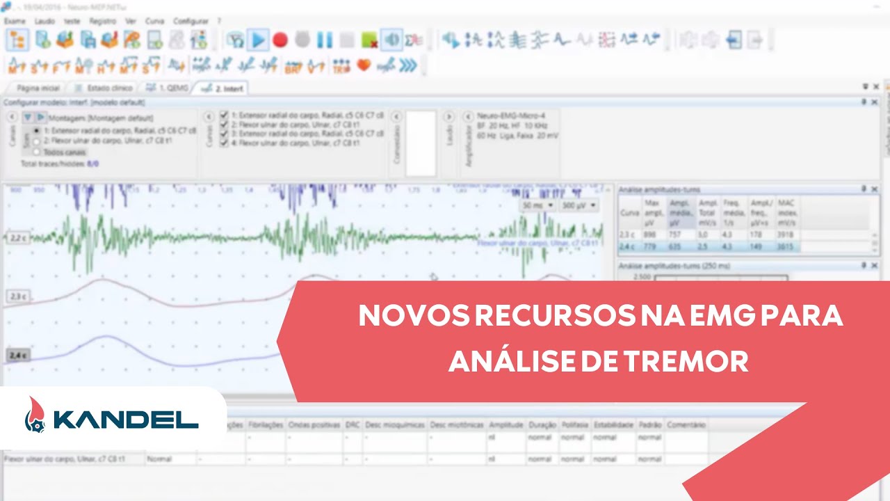 Novos Recursos na EMG para Análise de Tremor, Movimento e Interpretação da Agulha