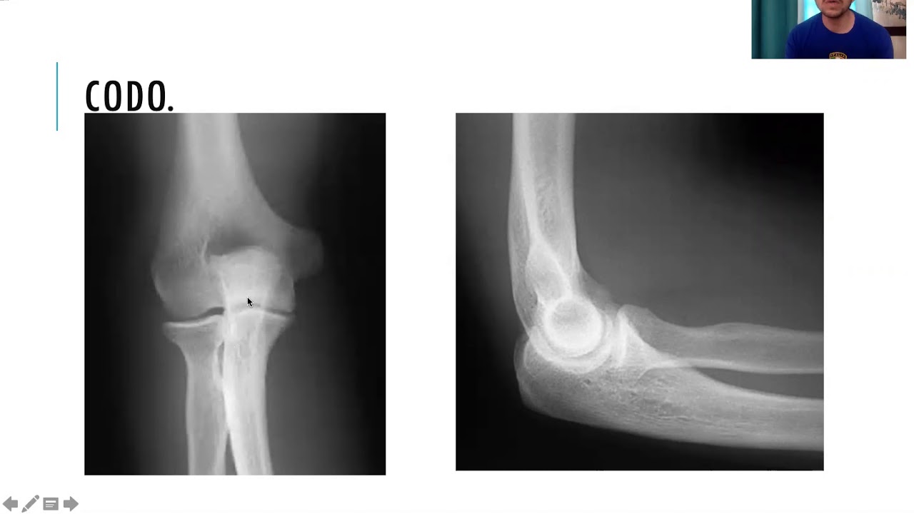 Radiología simple de miembro superior.