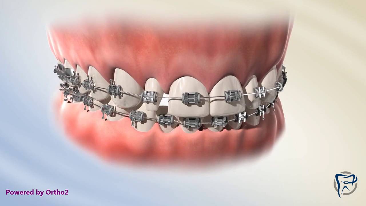 Peg Lateral (Veneer)