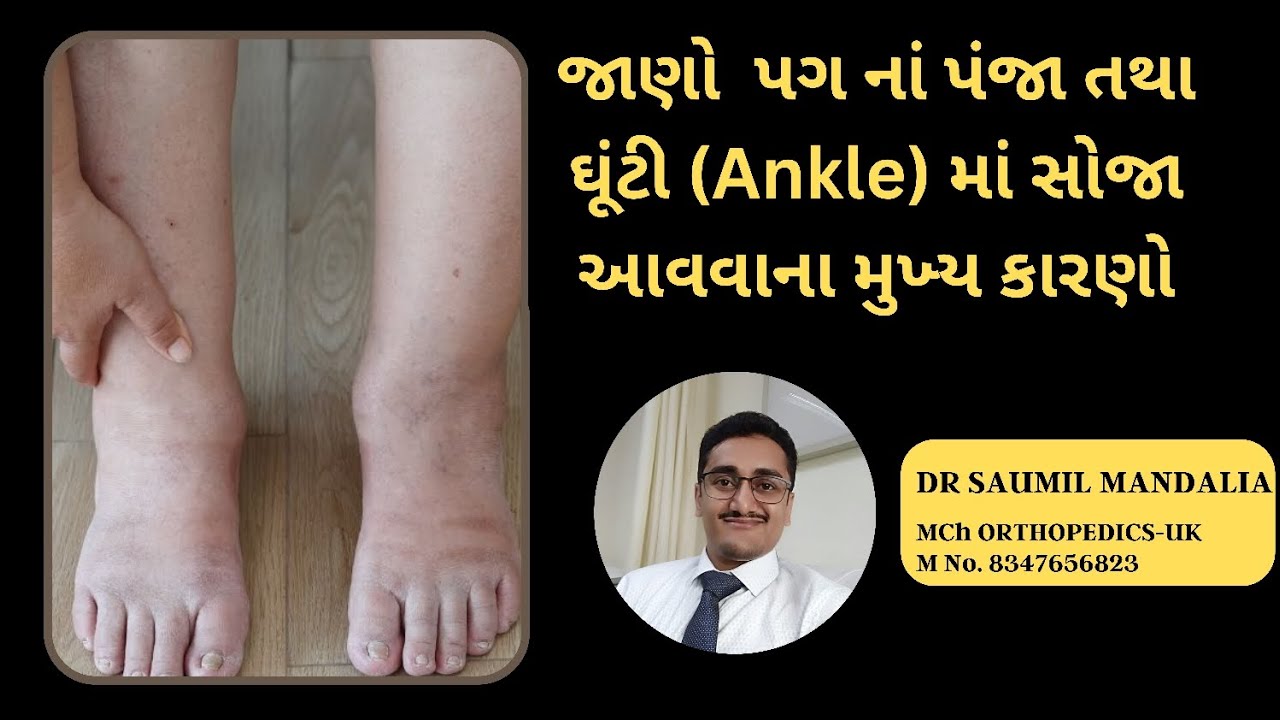 પગનાં પંજા માં તથા ઘૂંટી (ankle) માં સોજા આવવાના પ્રમુખ કારણો. (ગુજરાતી) #legswelling #orthopedic