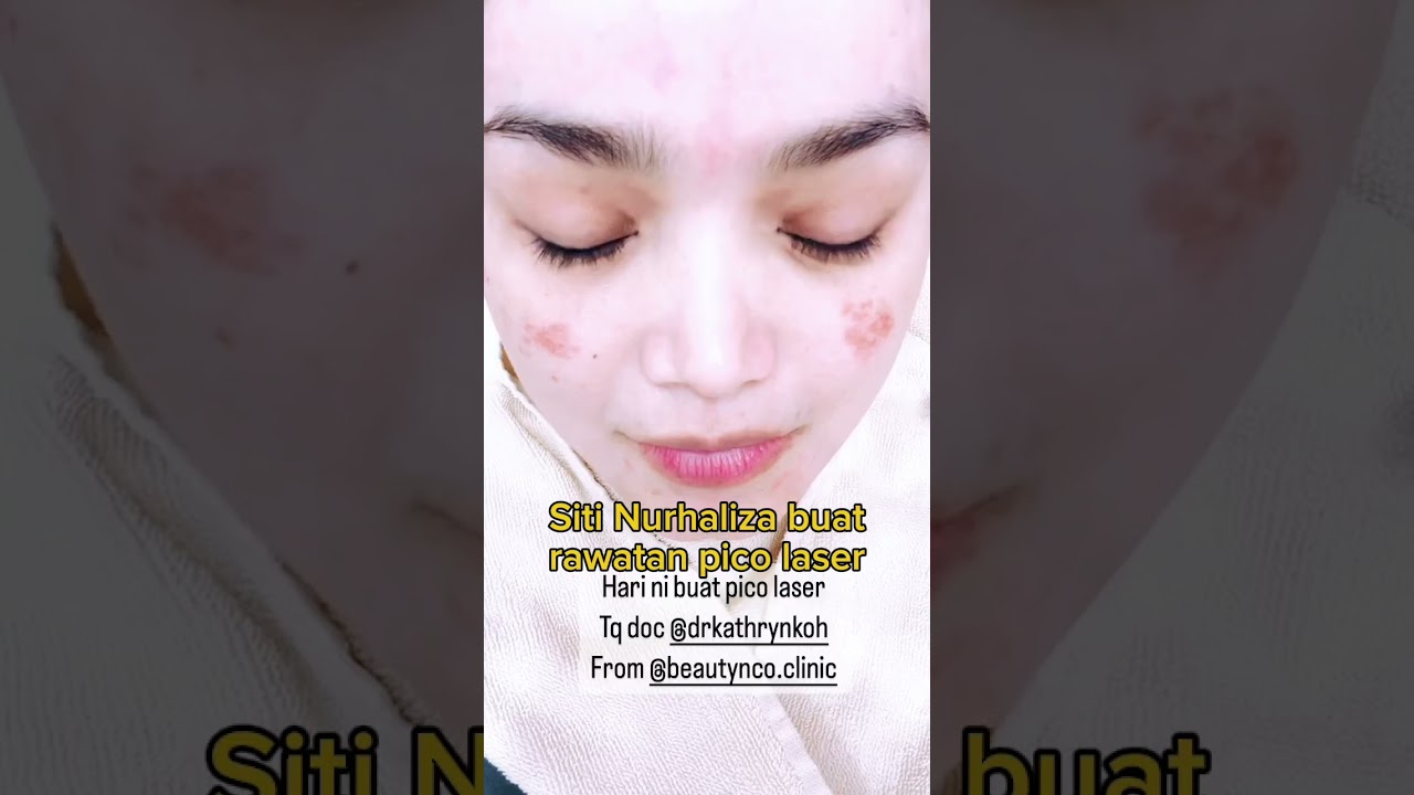 Siti Nurhaliza Buat Rawatan Pico Laser