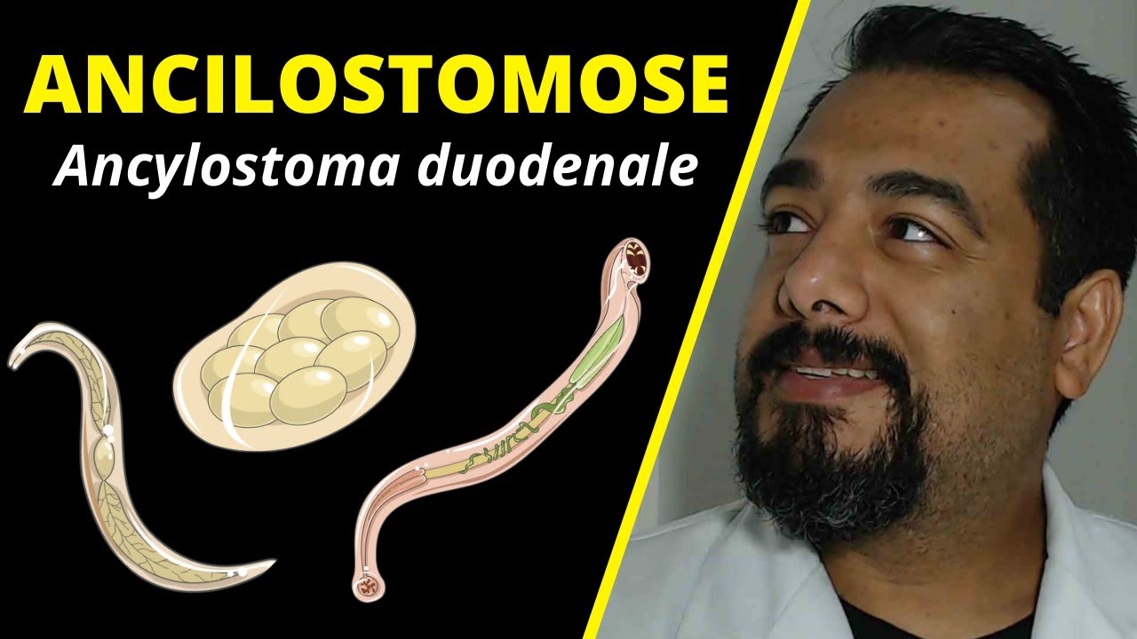 Ancilostomose ou Amarel&atilde;o (Ancylostoma): ciclo, sintomas e diagn&oacute;stico | Curso de #Parasitologia