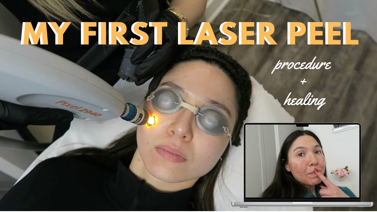 Pixel laser resurfacing facial (treatment and recovery)