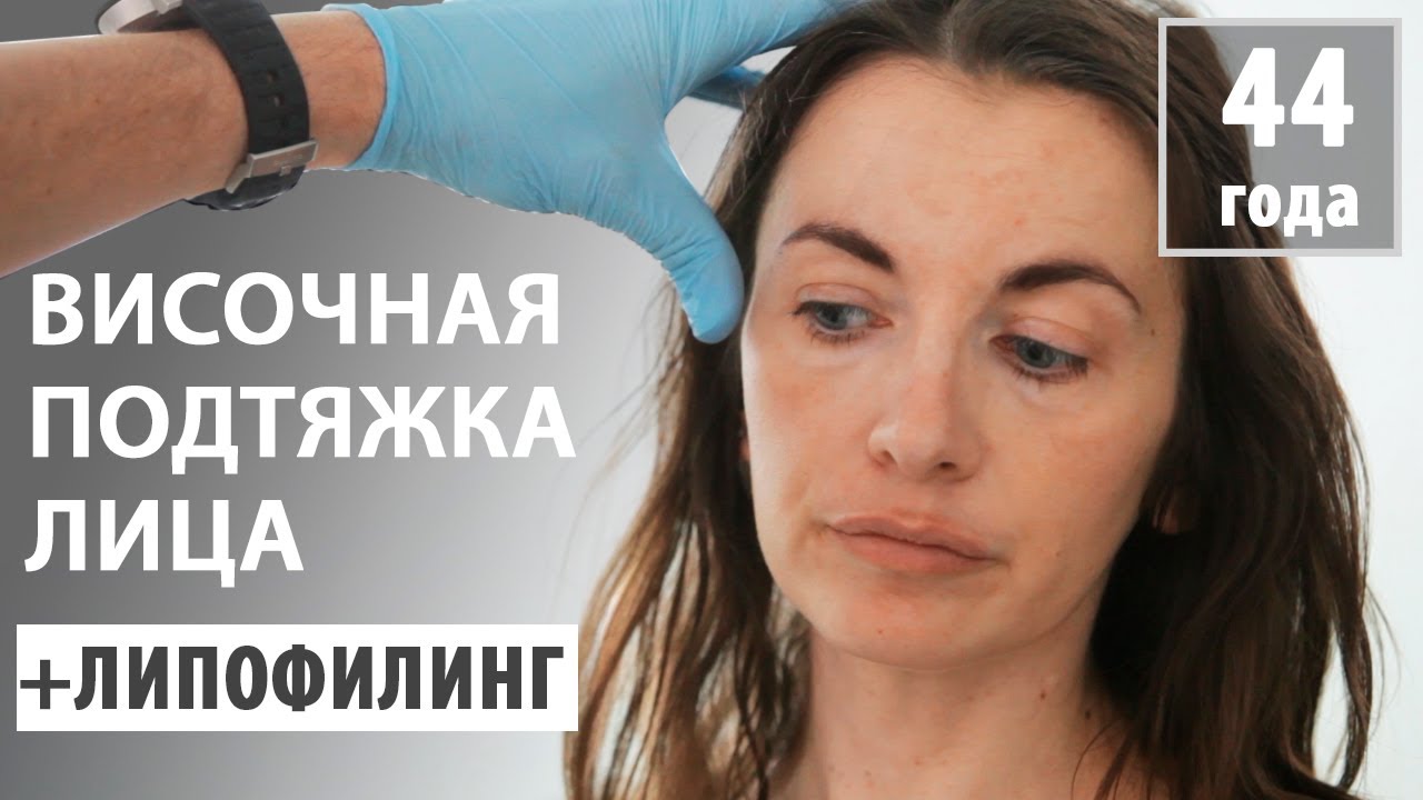 Подтяжка лица с липофилингом (пациентке 44 года)