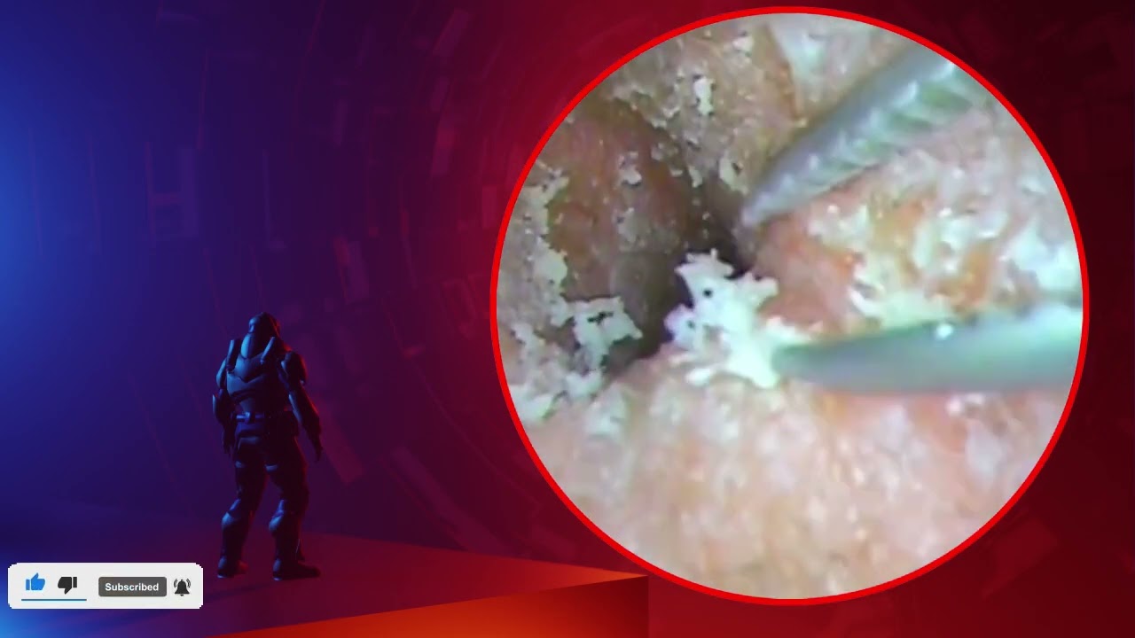 The Truth About earwax Will Shock You. How to remove earwax from ear, earwax extractions