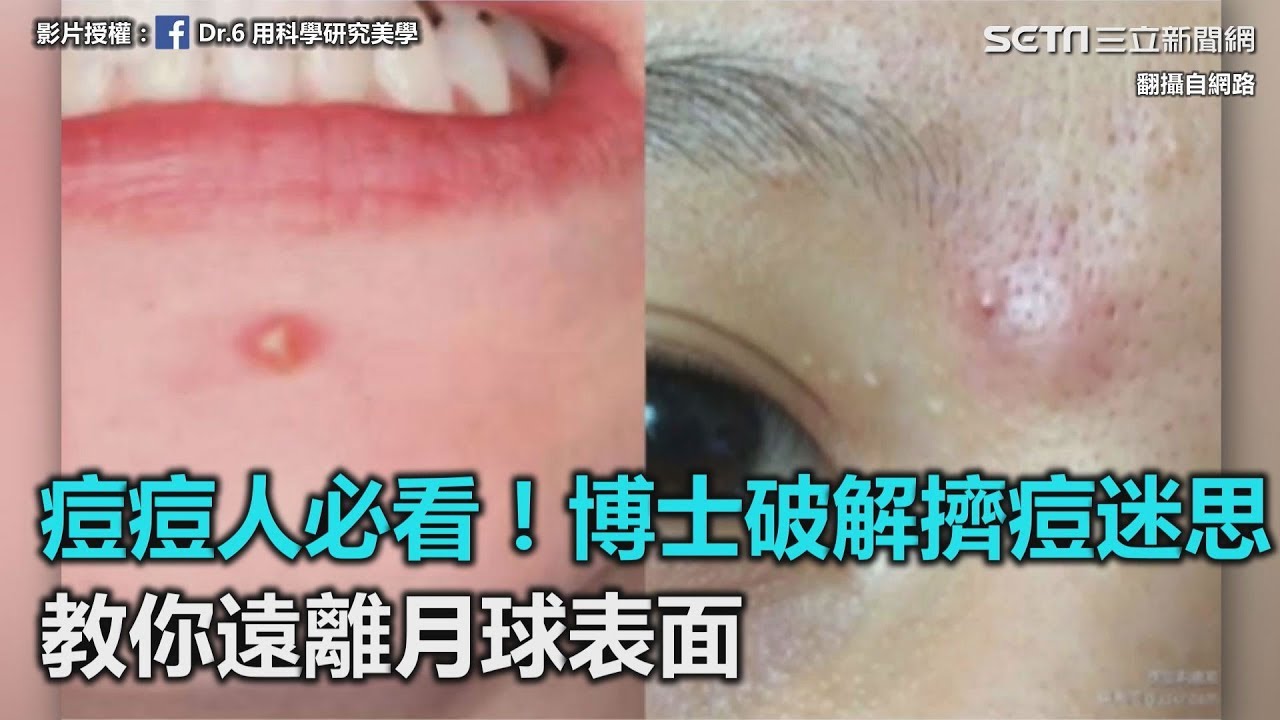 痘痘人必看！博士破解擠痘迷思　教你如何遠離月球表面｜三立新聞網SETN.com