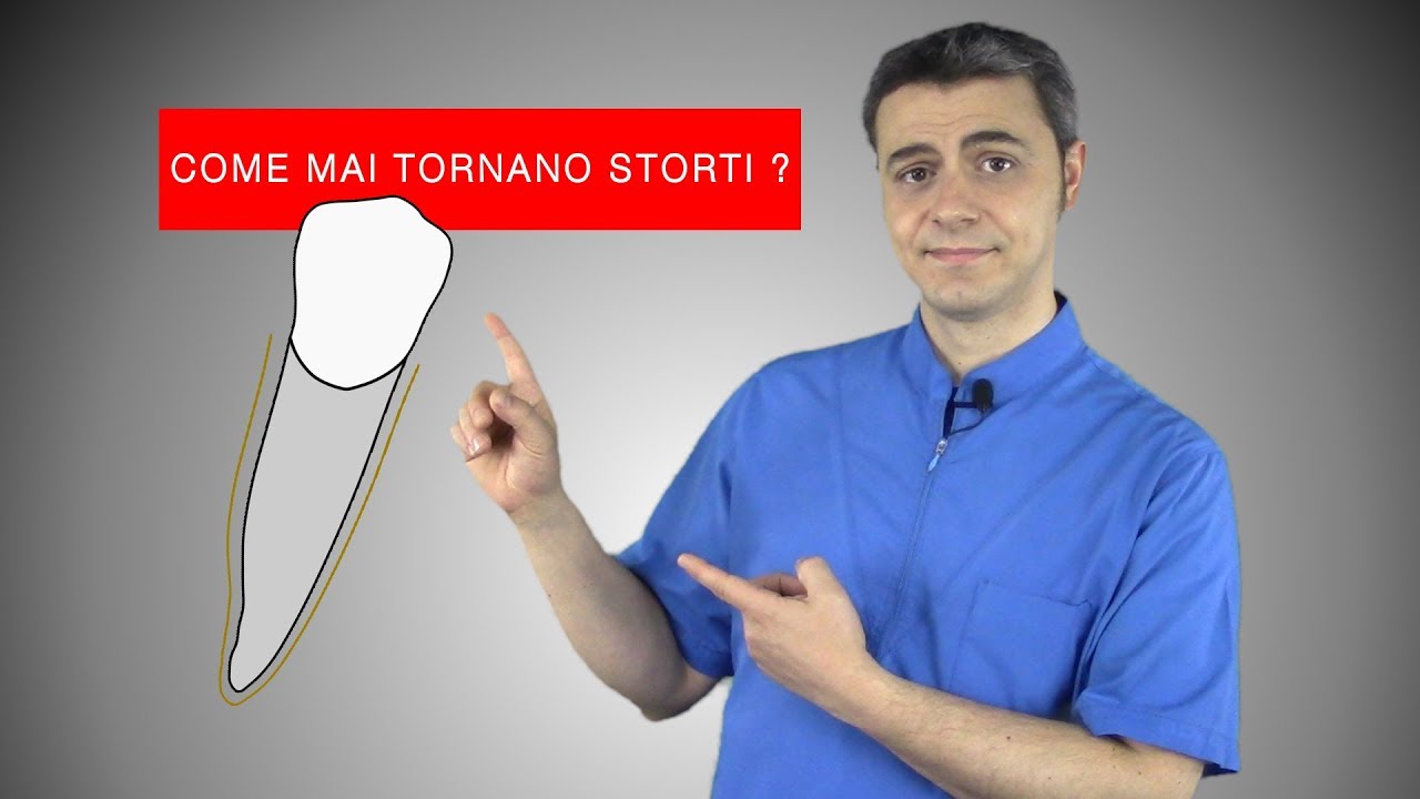 Come l'apparecchio allinea i denti (e perché tornano storti)