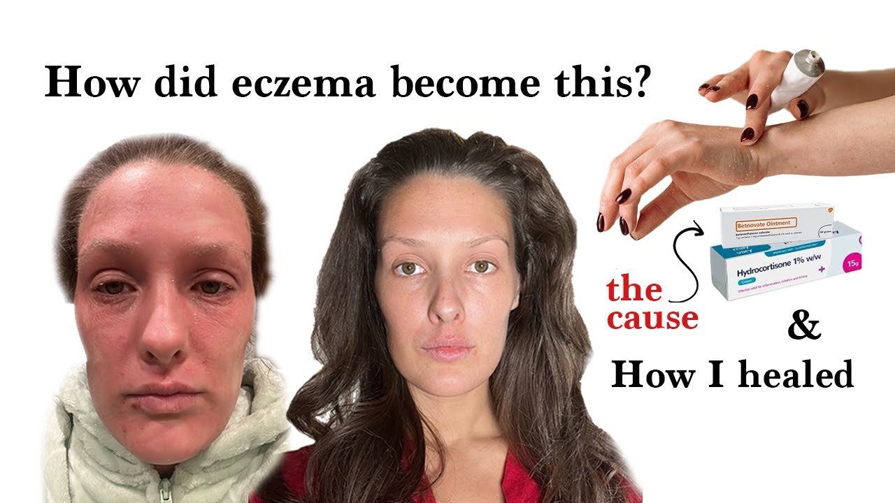 How my doctors ruined my life - Topical Steroid Withdrawal - TSW