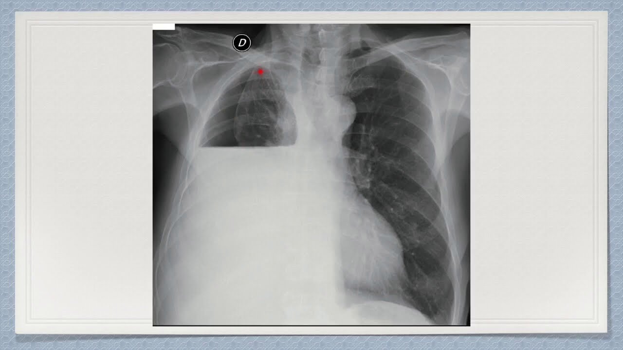 Derrame pleural