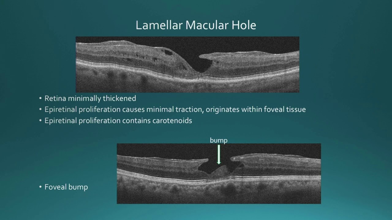 RET02 08   Section I Vitreoretinal Surgery, Part I   Should We Operate on Lamellar Macular Holes