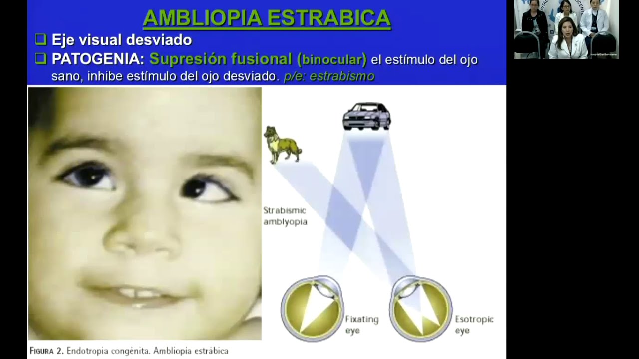 AMBLIOPIA (OJO PEREZOSO)