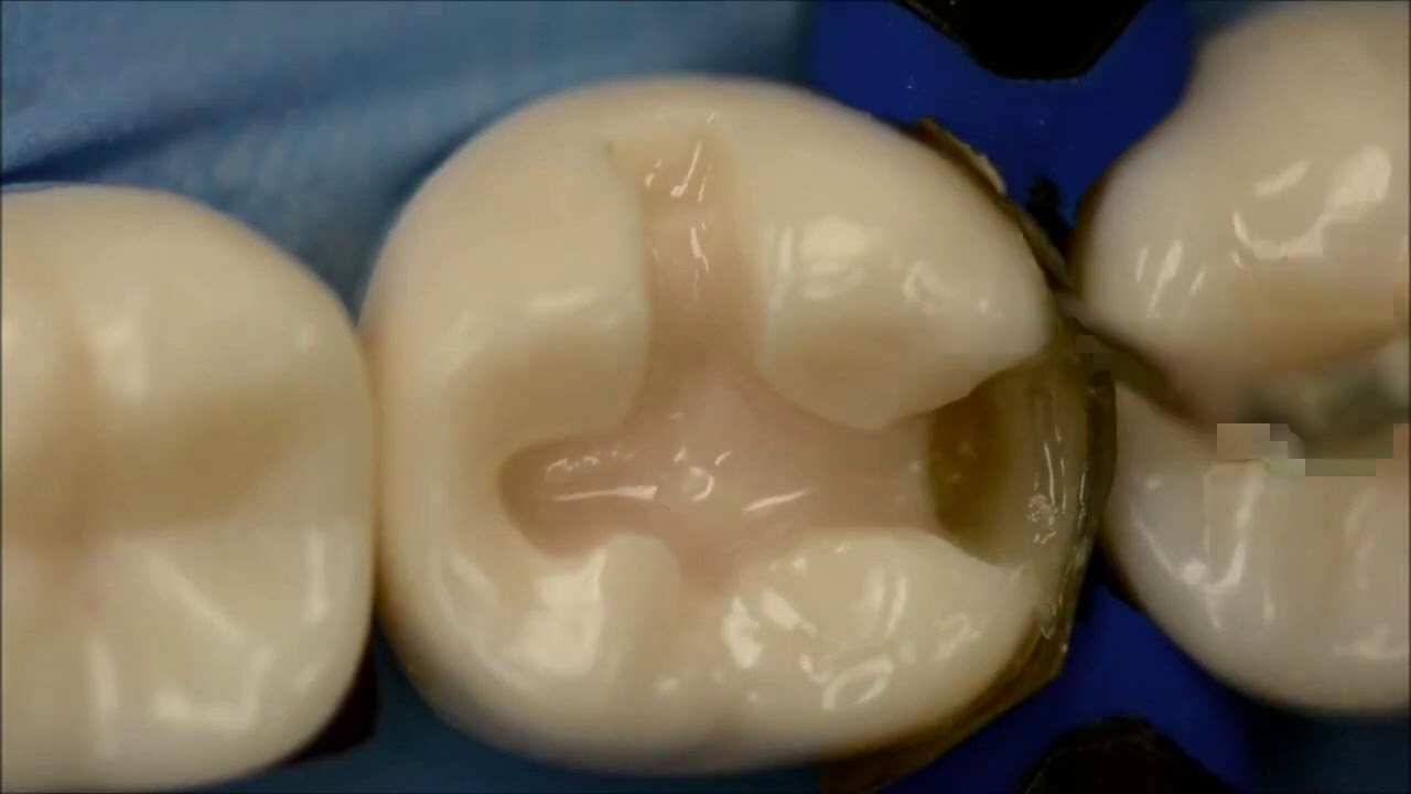 Class II Composite Marginal Ridge Build-up by Dr. Alex Delgado