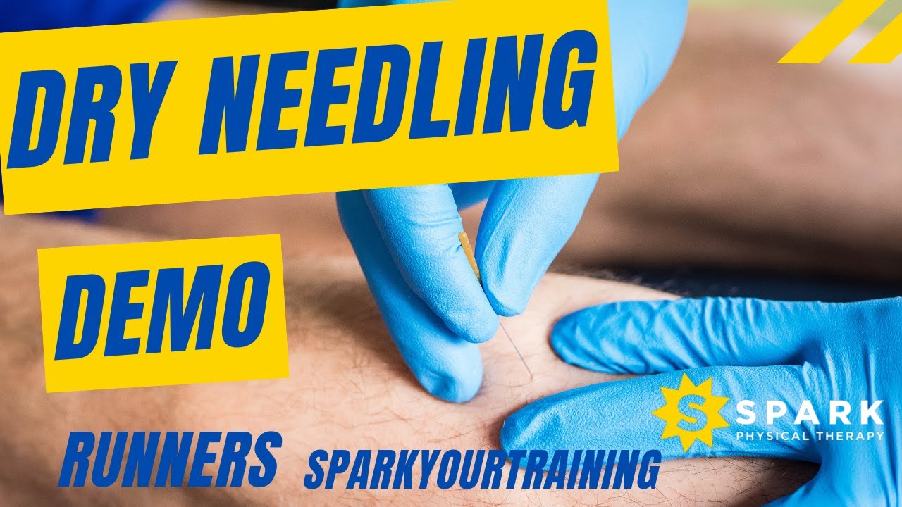 Dry Needling Near Me Demonstration | Is Dry Needling The Same As Acupuncture