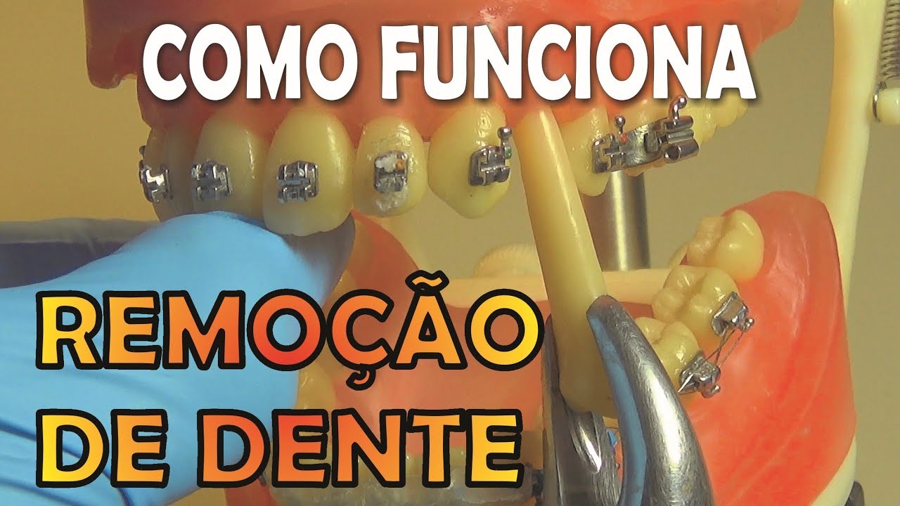 COMO FUNCIONA EXTRA&Ccedil;&Atilde;O DE DENTE