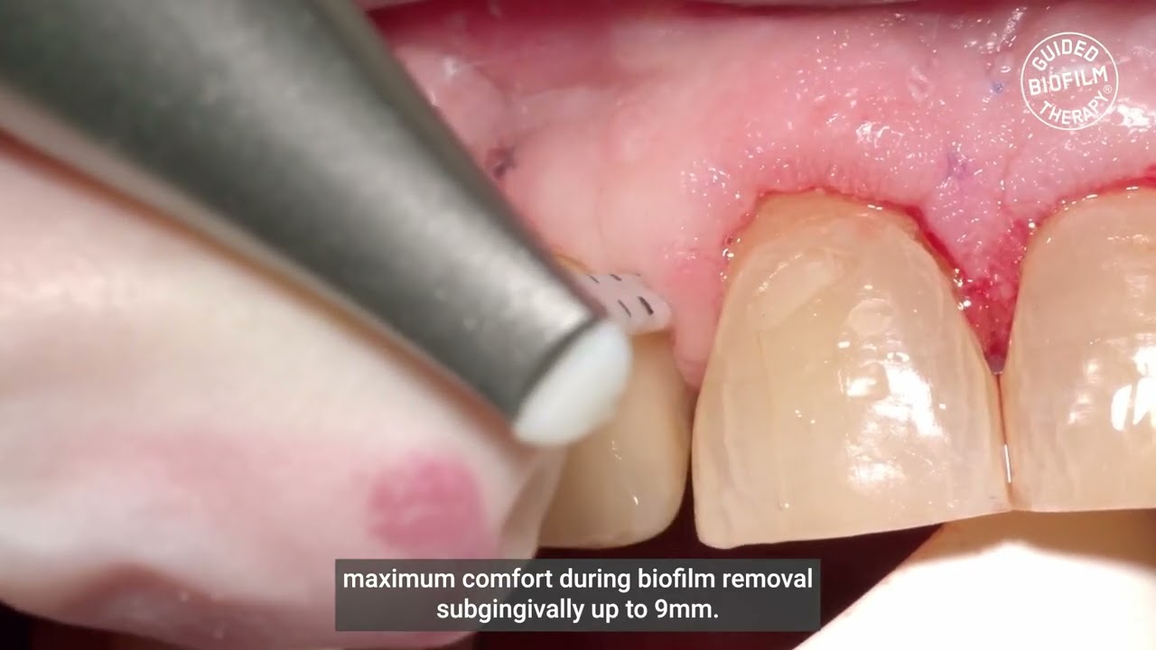 PERIOFLOW NOZZLE&mdash;MINIMALLY INVASIVE AND CLINICALLY PROVEN I GBT Microlearning with Vanessa Borken