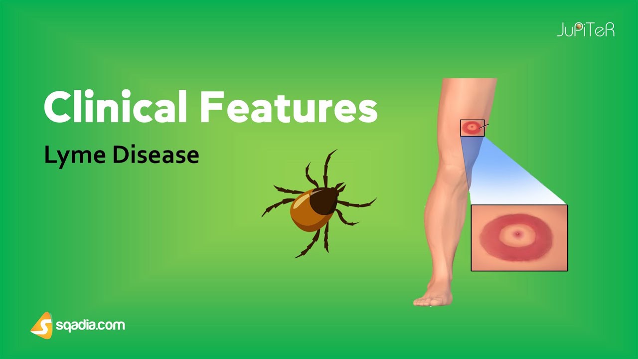 Lyme Disease | Clinical Features | Causes, Stages, Pathophysiology, Microbiology | V-Learning