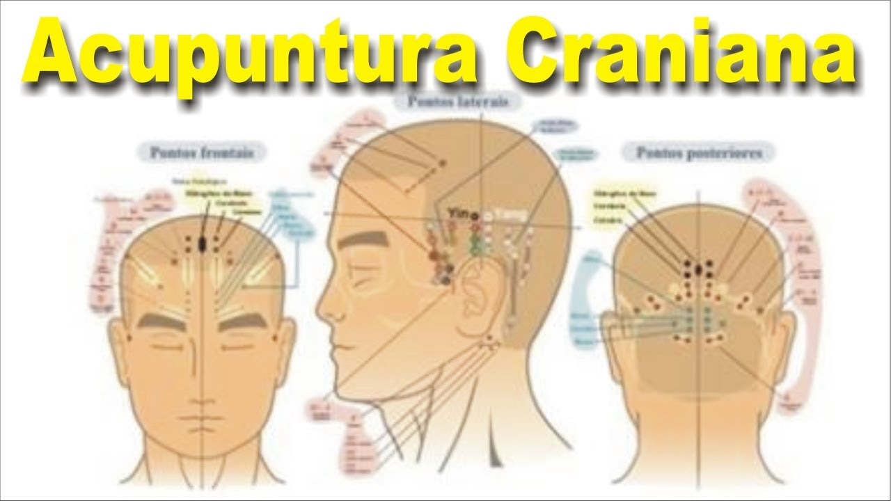 Craniopuntura de Yamamoto - Conheça a Técnica maravilhosa de Microssistema