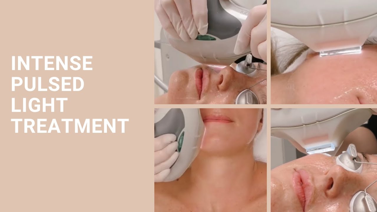 IPL Treatment