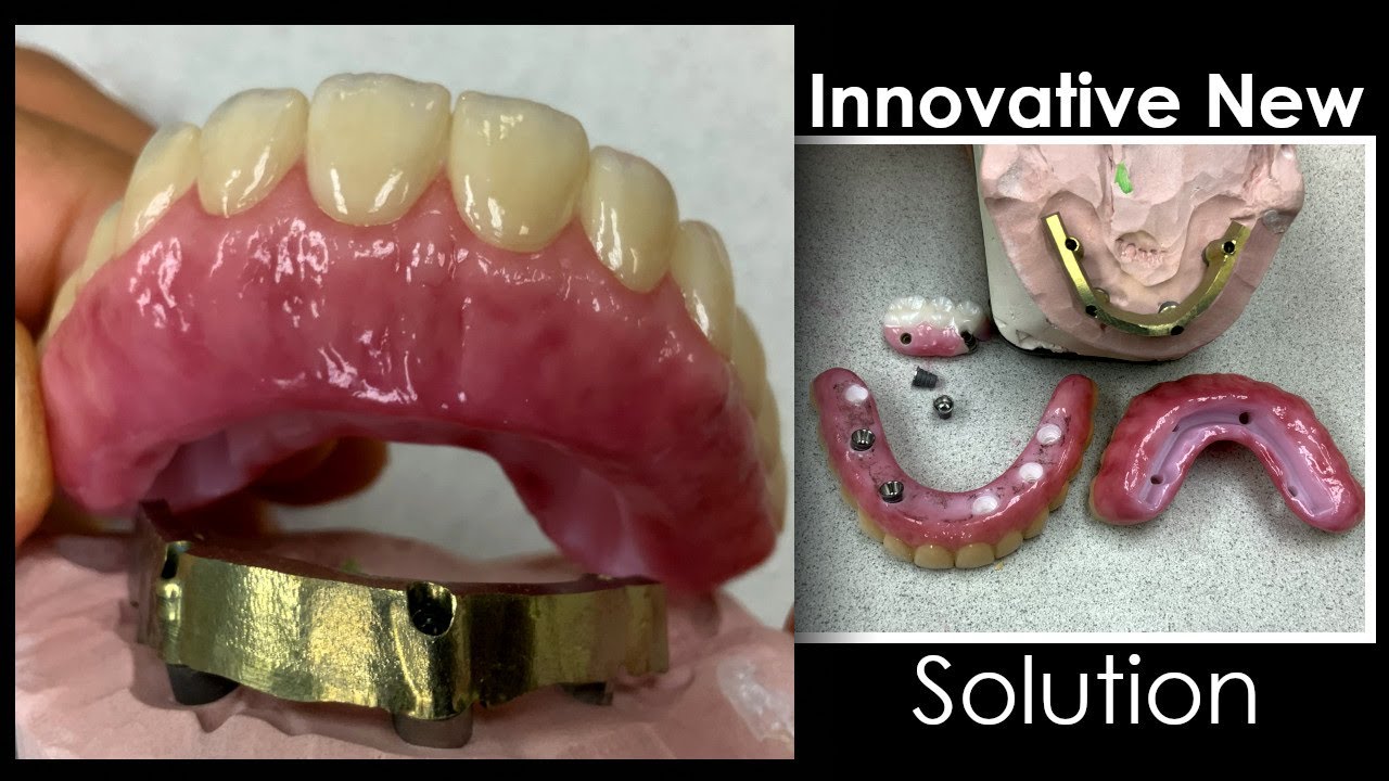 Innovative Solution for Preventing Titanium Base from Failing