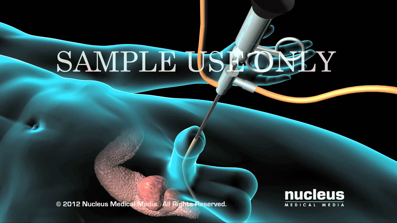 Resecci&oacute;n transuretral de la pr&oacute;stata (TURP)