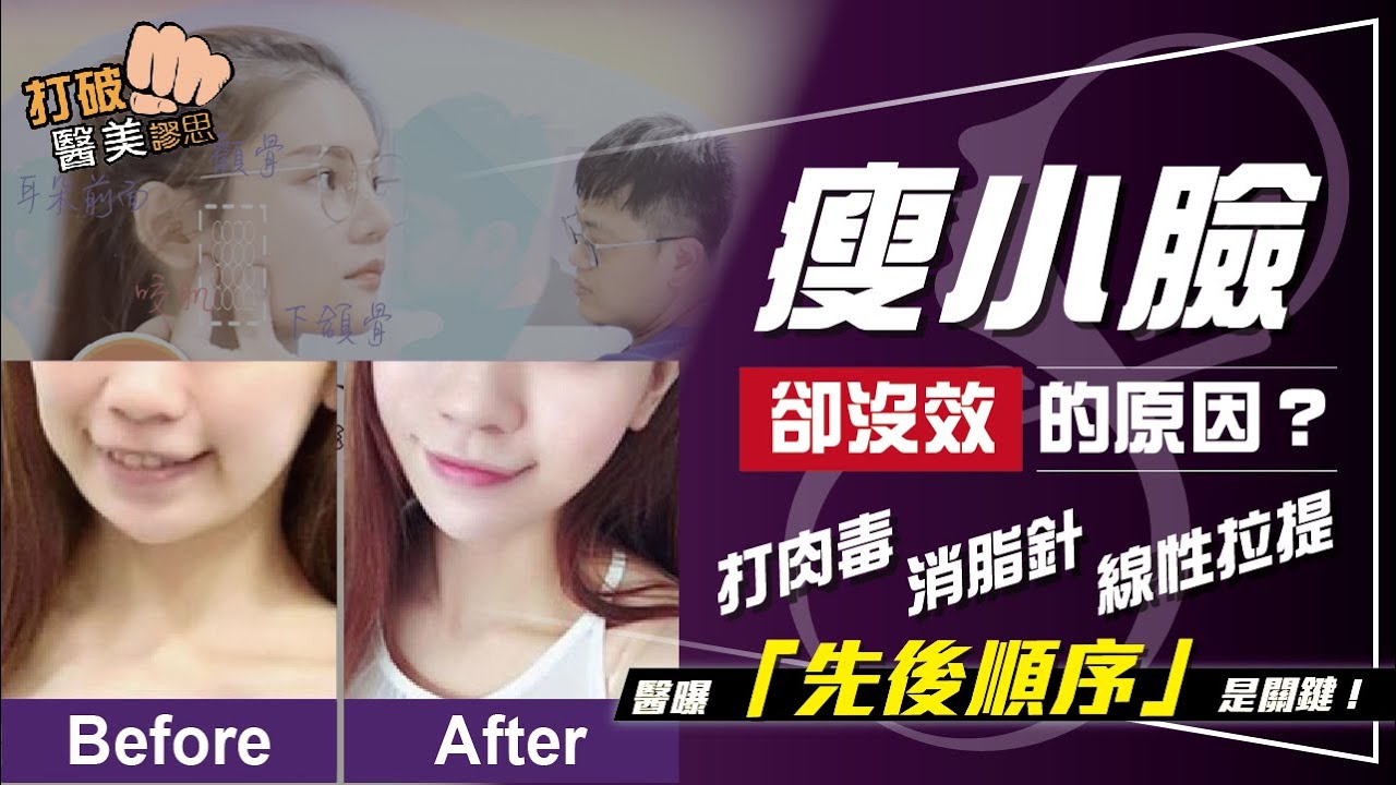 肉毒VS消脂針VS線雕(線性)拉提     選哪一種才能有效瘦小臉？　效果太差都是這個「原因」 打破醫美謬思 221-20210810