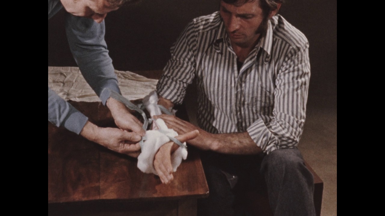 Immobilisation de fractures du membre sup&eacute;rieur ( 1976 )