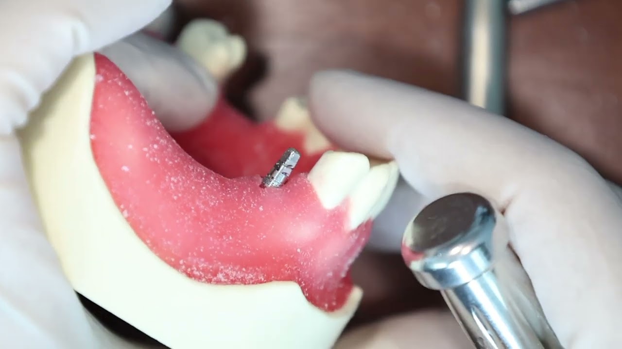 Monoimplant Placement Demo (Flapless Approach)