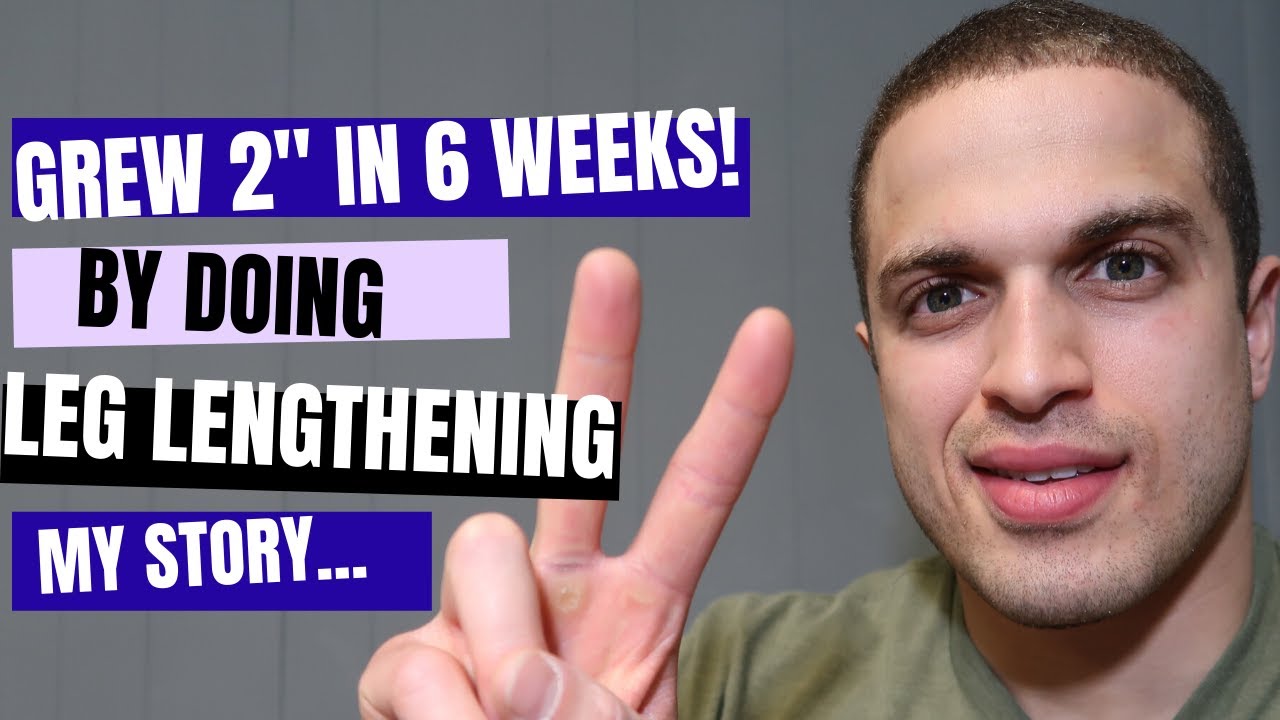Как я стал выше благодаря операции по удлинению конечностей — Виктор Эгоню