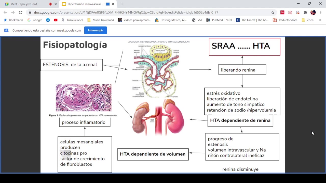 Hipertensión Reno Vascular