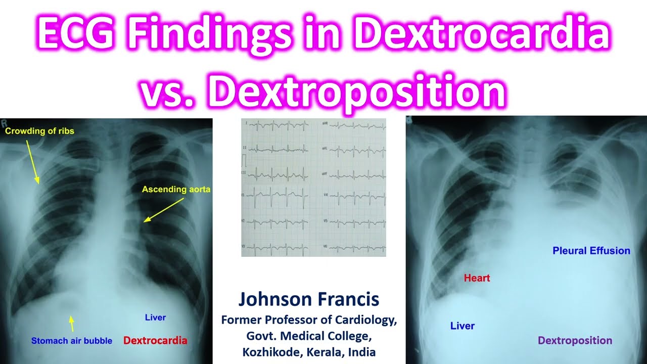 ECG Findings in Dextrocardia vs  Dextroposition