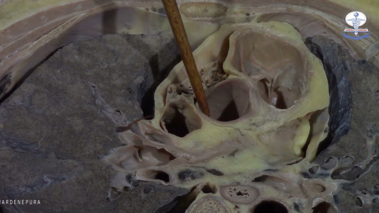 Cadaveric Demonstration Cross section at T4,T5 level by Dr Sajith Edirisinghe