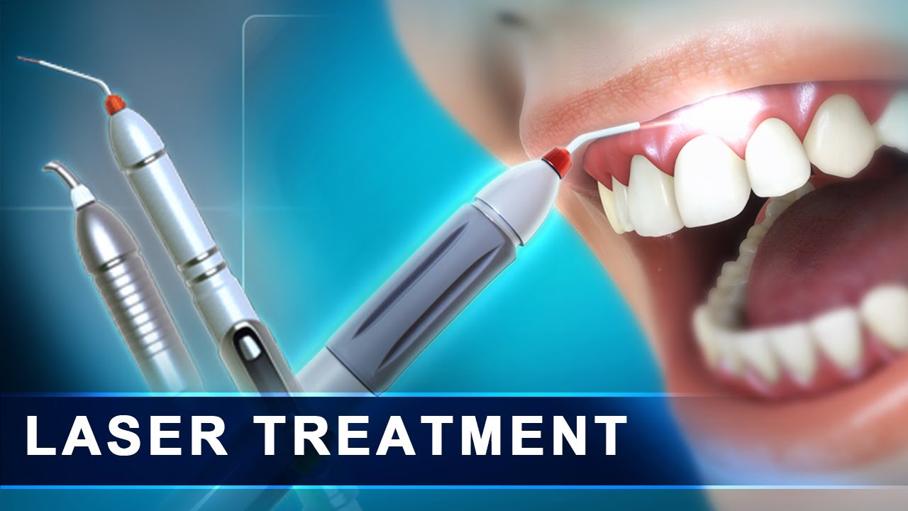 LASER DENTISTRY
