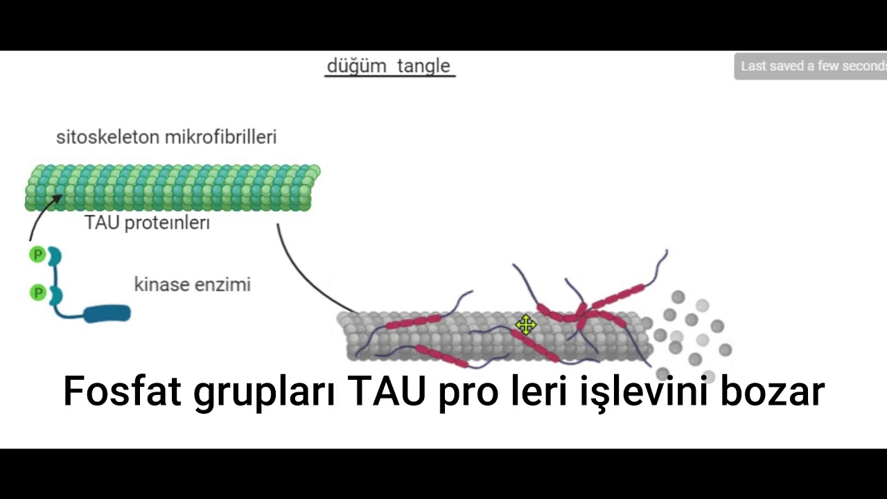 Alzheimer Hastalığı-Plaklar, D&uuml;ğ&uuml;mler, APP , TAU , Tangles ,Kinase, APOE e4