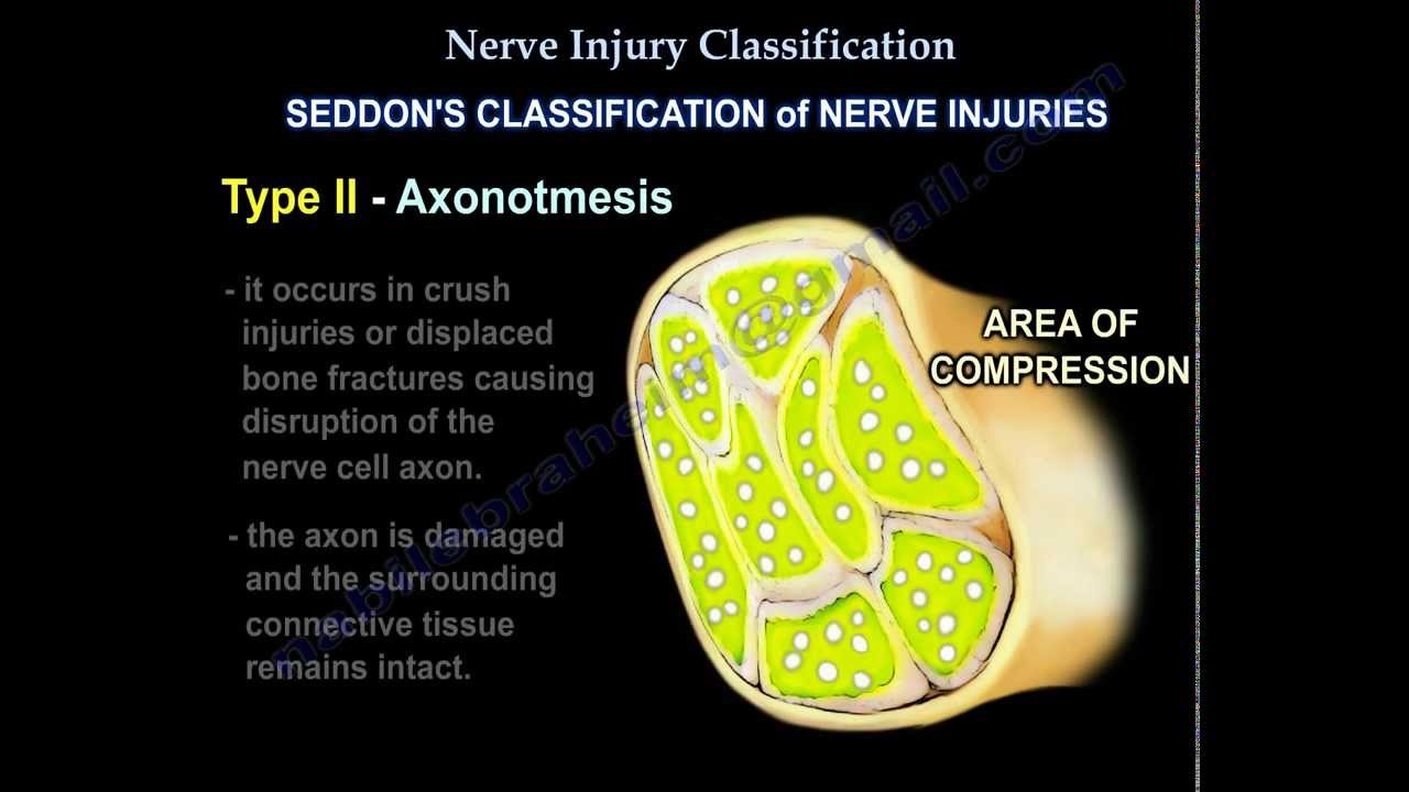 Nerve Injury ,types . Nerve recovery  - Everything You Need To Know - Dr. Nabil Ebraheim