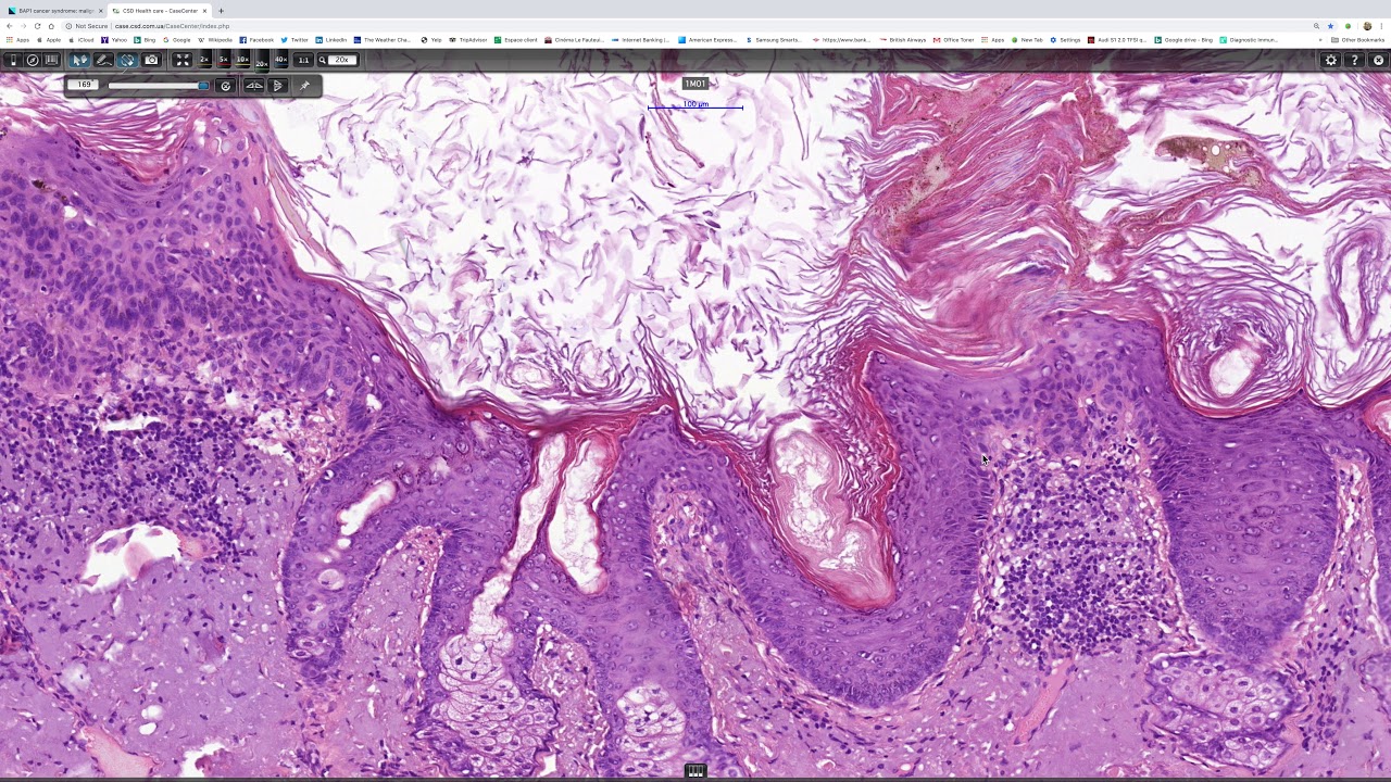 Actinic keratosis Phillip McKe, Antonina Kalmykova, CSD Health Care