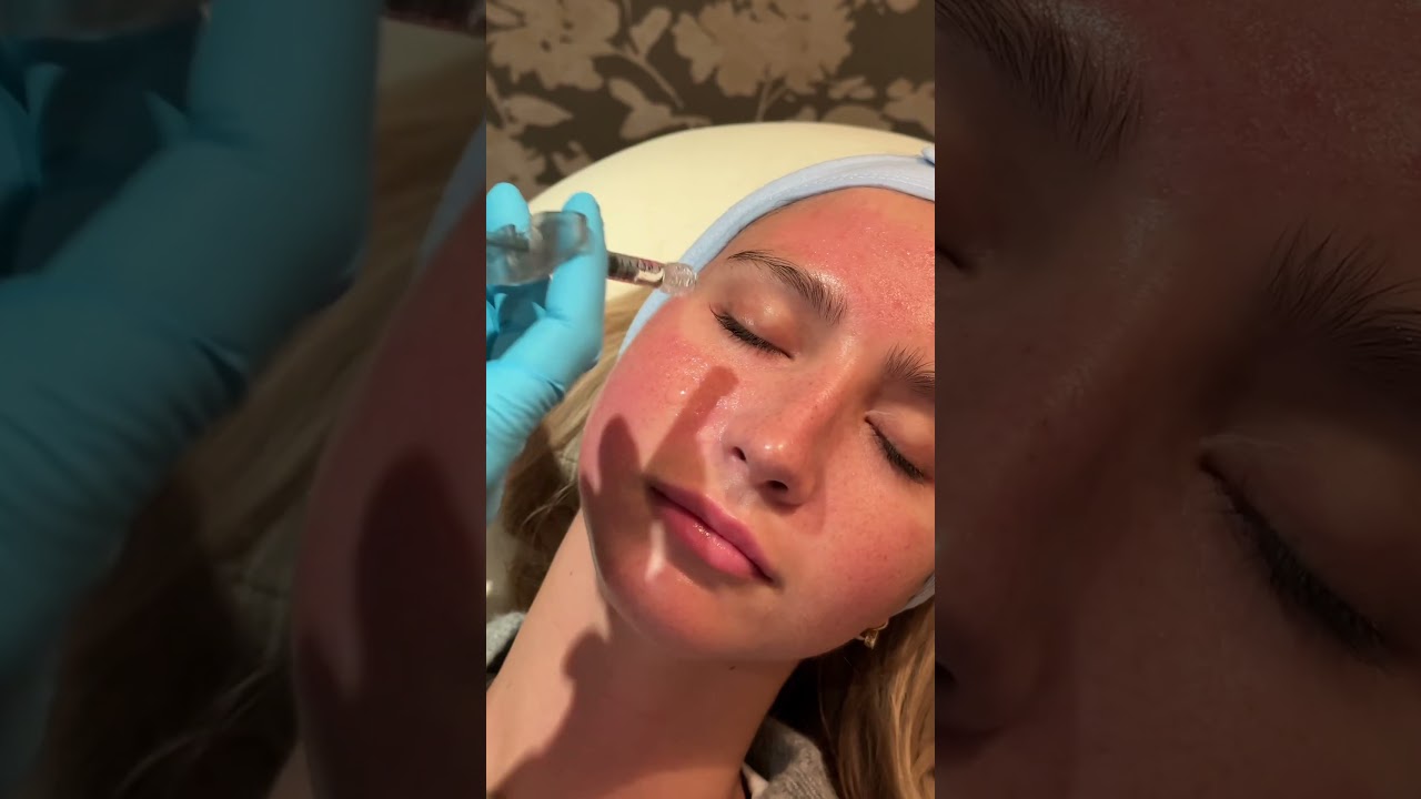 Microneedling with VAMP PDRN ✨✨